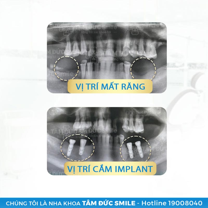 dịch vụ trồng răng implant tâm đức smile