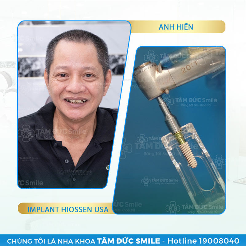 dịch vụ trồng răng implant tâm đức smile