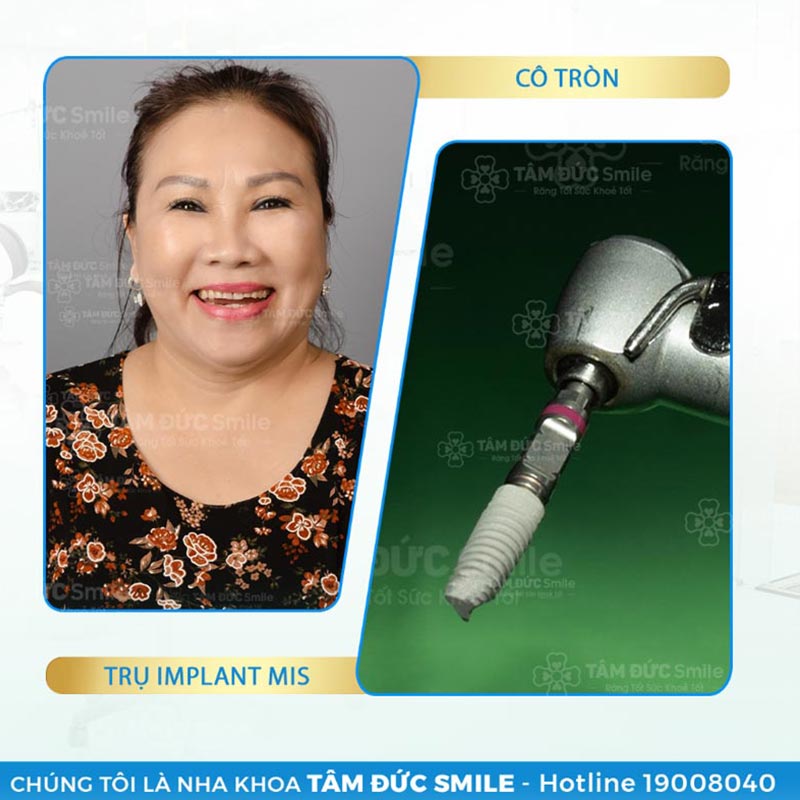 dịch vụ trồng răng implant tâm đức smile