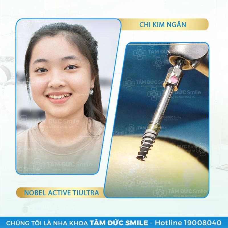 dịch vụ trồng răng implant tâm đức smile