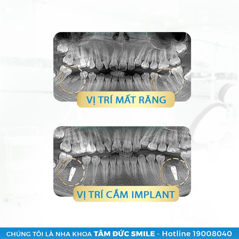 dịch vụ trồng răng implant tâm đức smile