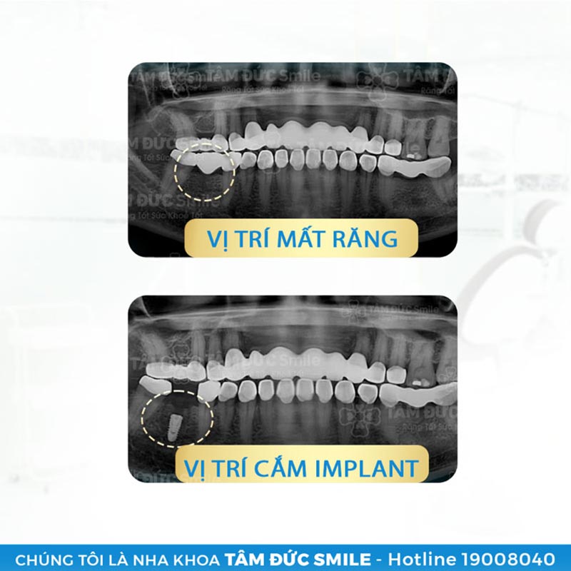 dịch vụ trồng răng implant tâm đức smile