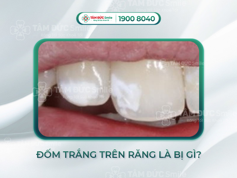 [GIẢI ĐÁP] ĐỐM TRẮNG TRÊN RĂNG CÓ ẢNH HƯỞNG GÌ KHÔNG? CÁCH CHỮA TRỊ