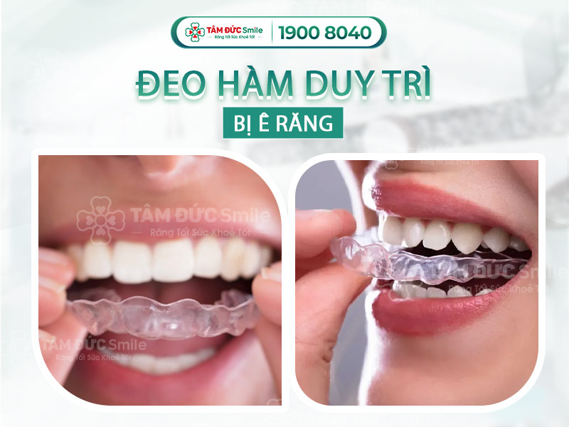 Ê RĂNG KHI ĐEO HÀM DUY TRÌ: NGUYÊN NHÂN VÀ CÁCH KHẮC PHỤC HIỆU QUẢ