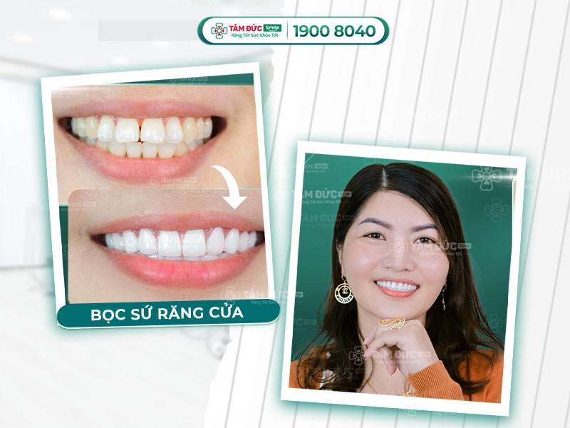 GIÁ BỌC SỨ RĂNG CỬA BAO NHIÊU TIỀN?