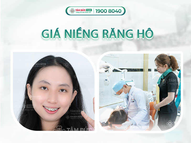 GIÁ CHI PHÍ NIỀNG RĂNG HÔ MỚI NHẤT 2025