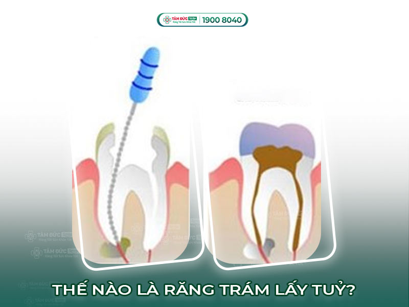 TRÁM RĂNG LẤY TUỶ LÀ GÌ? ƯU NHƯỢC ĐIỂM TRÁM RĂNG LẤY TUỶ