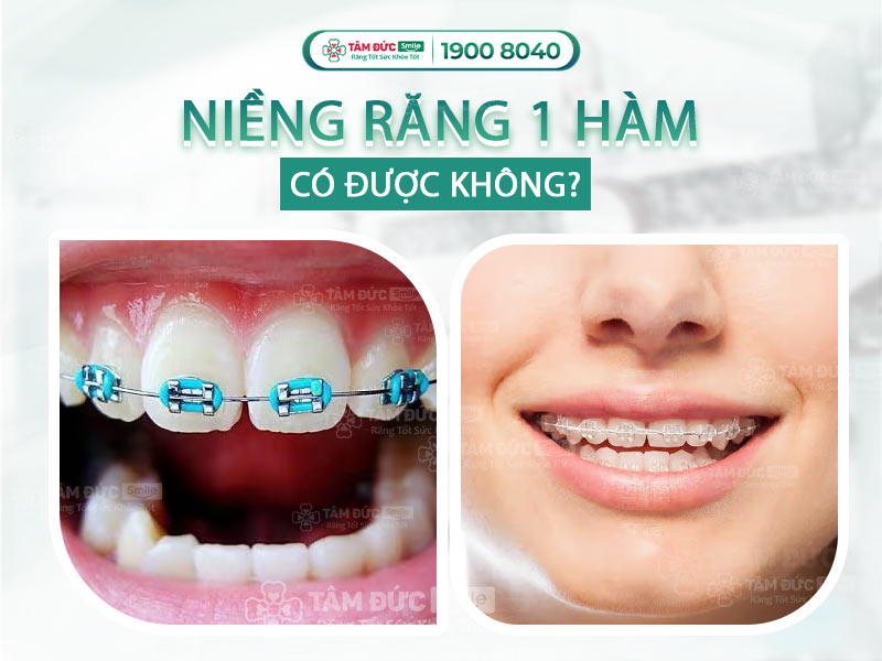 NIỀNG RĂNG 1 HÀM CÓ THỂ ĐƯỢC HAY KHÔNG? GIÁ NIỀNG RĂNG MỘT HÀM MỚI NHẤT 2025