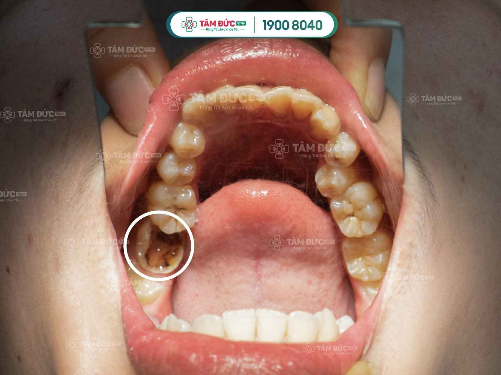 giá trám răng sâu tại nha khoa Tâm Đức Smile