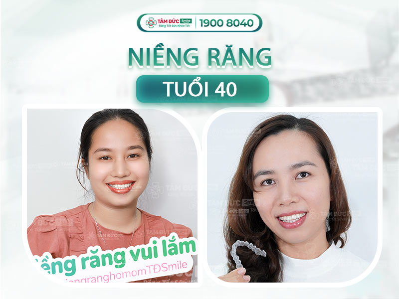 [GIẢI ĐÁP] 40 TUỔI NIỀNG RĂNG ĐƯỢC KHÔNG? ÁP DỤNG PHƯƠNG PHÁP NÀO?