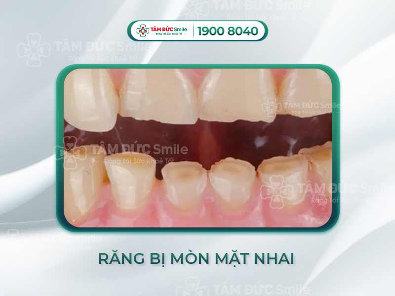 GIẢI ĐÁP: RĂNG BỊ MÒN MẶT NHAI PHẢI LÀM SAO?