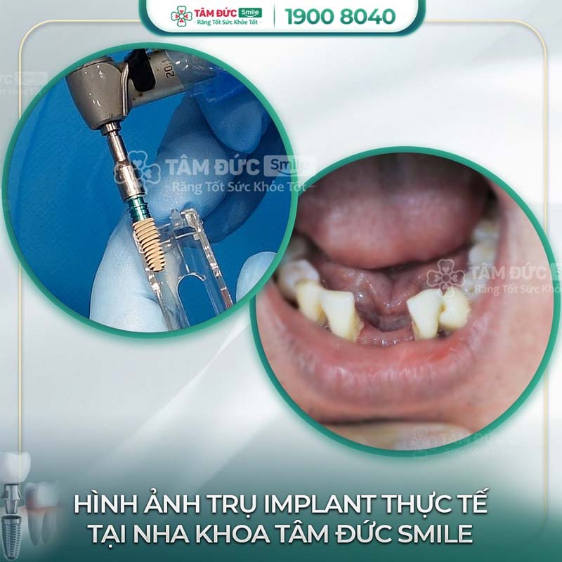 khách hàng trồng răng implant tại nha khoa Tâm Đức Smile sau khi nhổ bỏ răng chết tuỷ