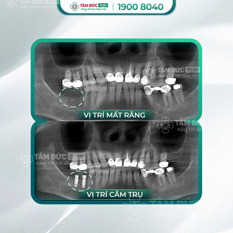 trồng răng implant sau khi nhổ răng chết tuỷ