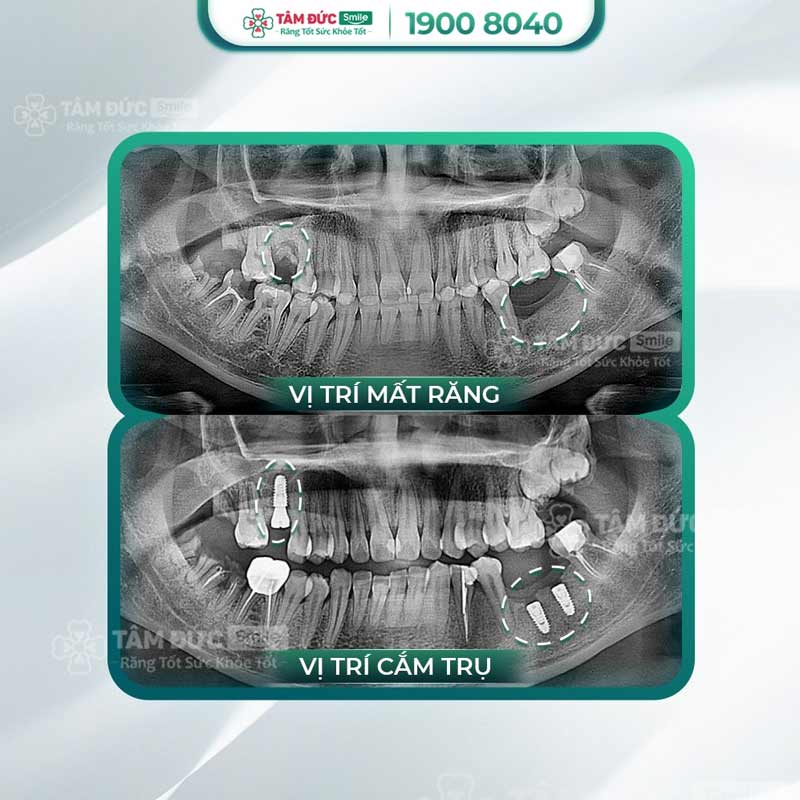 trồng răng implant sau khi nhổ răng chết tuỷ