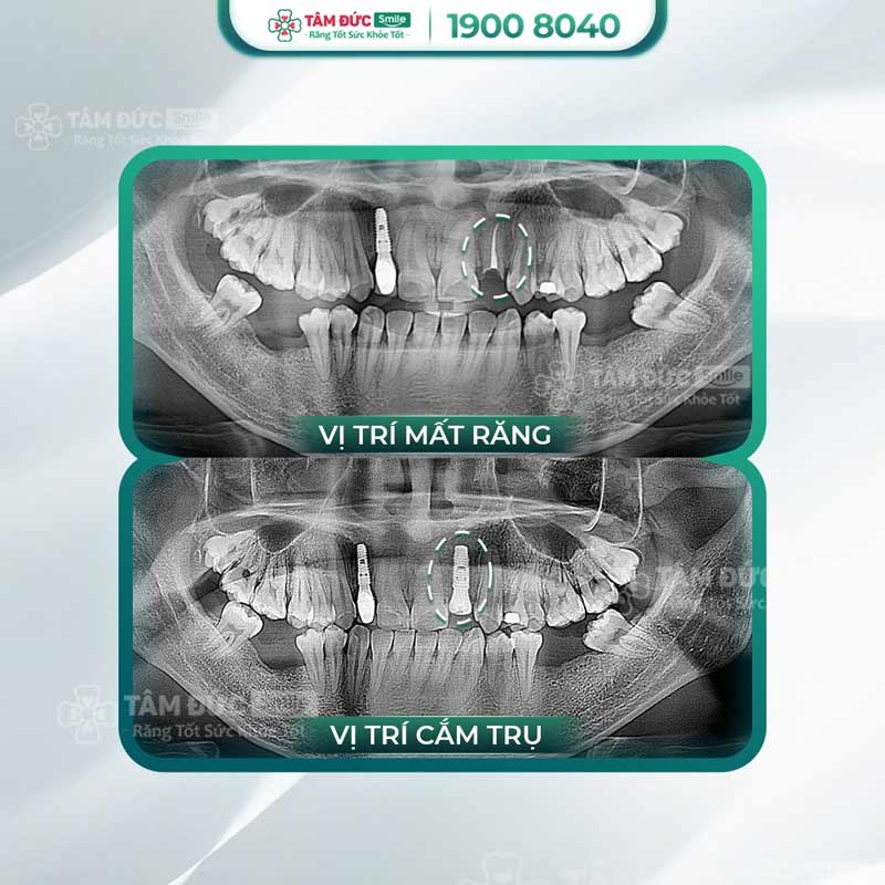 trồng răng implant sau khi nhổ răng chết tuỷ