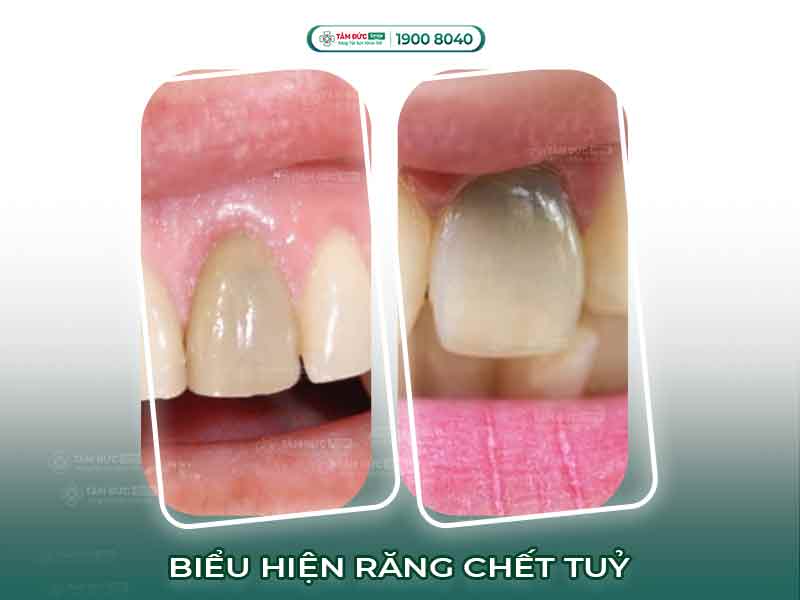 [GIẢI ĐÁP] RĂNG CHẾT TỦY ĐỂ LÂU CÓ SAO KHÔNG? CÁCH KHẮC PHỤC