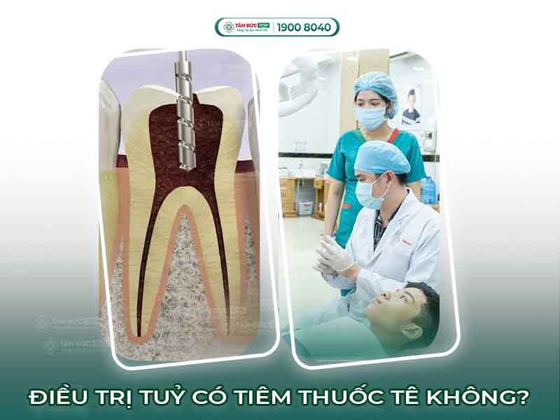 GIẢI ĐÁP THẮC MẮC: LẤY TỦY RĂNG CÓ TIÊM THUỐC TÊ KHÔNG?