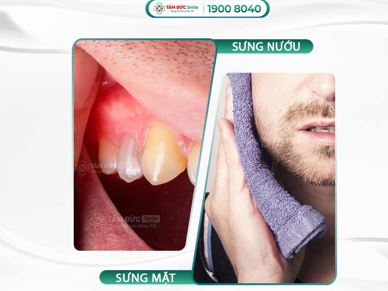 GIẢI PHÁP KHẮC PHỤC SƯNG NƯỚU RĂNG SƯNG MẶT AN TOÀN & HIỆU QUẢ