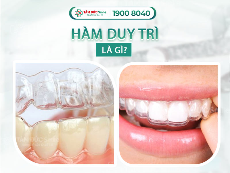 HÀM DUY TRÌ LÀ GÌ? LỢI ÍCH KHI ĐEO HÀM DUY TRÌ