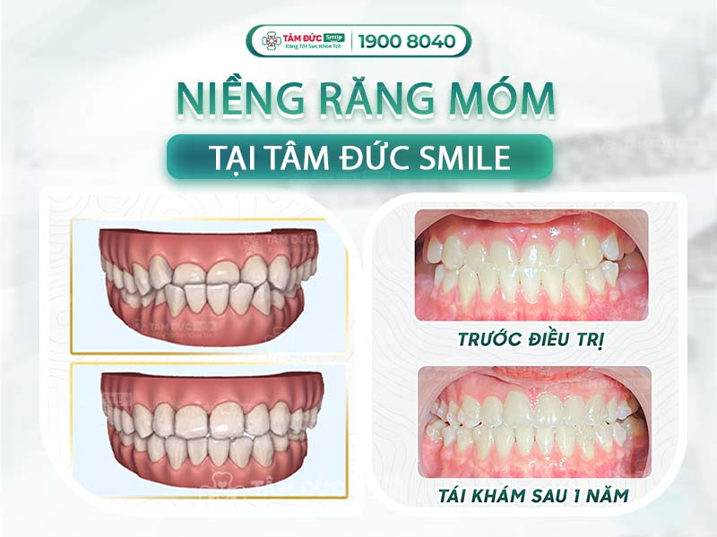 HÌNH ẢNH NIỀNG RĂNG MÓM TRƯỚC VÀ SAU KHI THÁO NIỀNG TẠI NHA KHOA TÂM ĐỨC SMILE