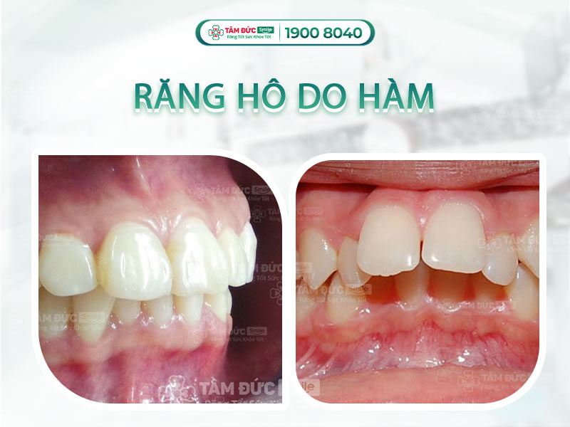 HÔ DO HÀM CÓ NIỀNG RĂNG ĐƯỢC KHÔNG? GIẢI ĐÁP TỪ CHUYÊN GIA