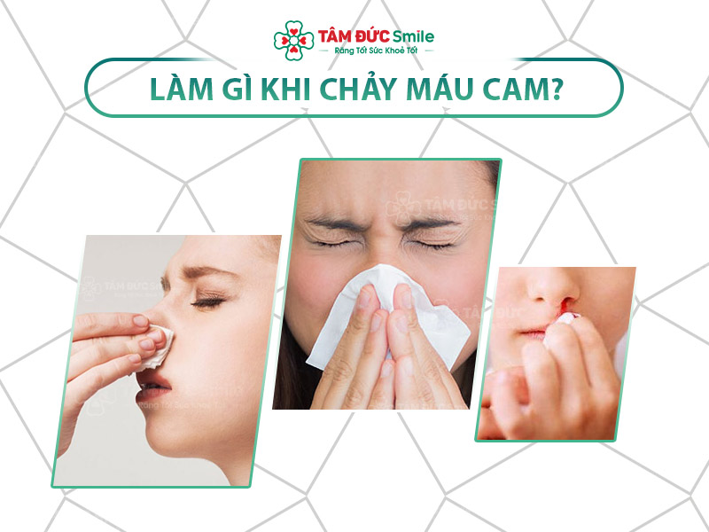 [HƯỚNG DẪN] BỊ CHẢY MÁU CAM CẦN LÀM GÌ? CÁCH PHÒNG NGỪA