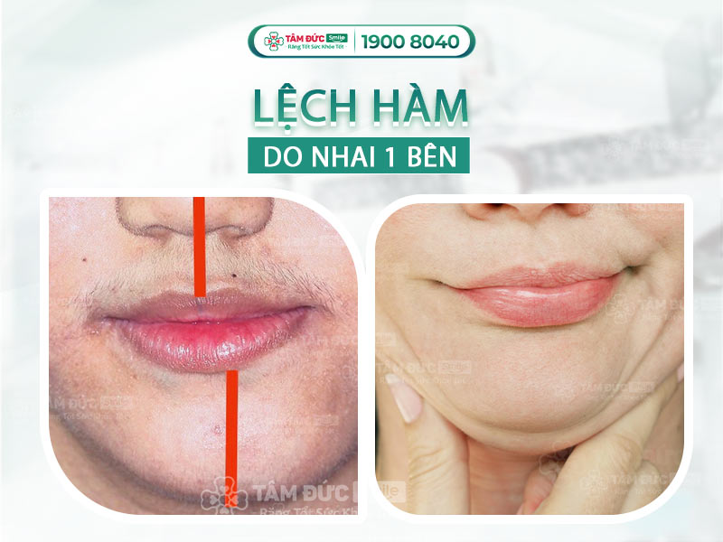 CÁCH KHẮC PHỤC THÓI QUEN NHAI 1 BÊN BỊ LỆCH HÀM