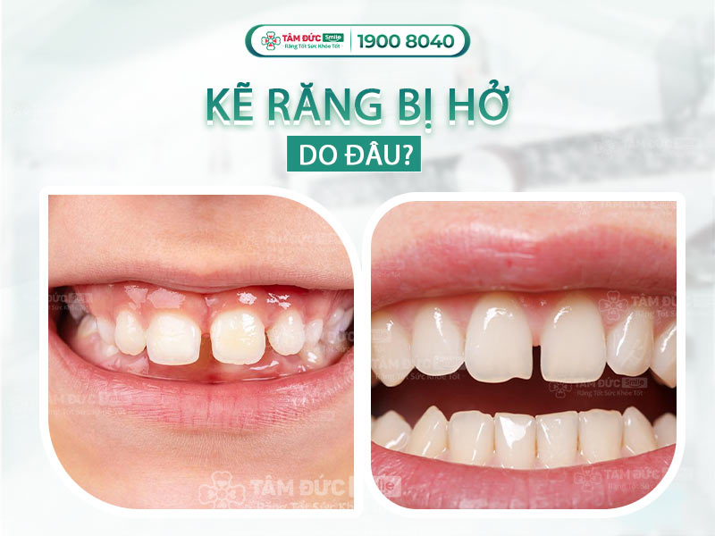 KẼ RĂNG BỊ HỞ LÀ DO ĐÂU? CÁCH KHẮC PHỤC HỞ KẼ RĂNG HIỆU QUẢ