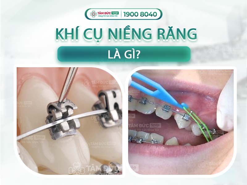 KHÍ CỤ NIỀNG RĂNG LÀ GÌ? CÓ NHỮNG LOẠI KHÍ CỤ NÀO?