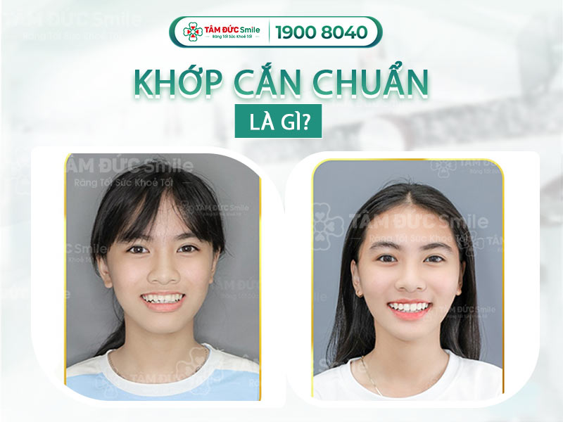 KHỚP CẮN CHUẨN LÀ NHƯ THẾ NÀO? BIỆN PHÁP CHỮA TRỊ LỆCH KHỚP CẮN