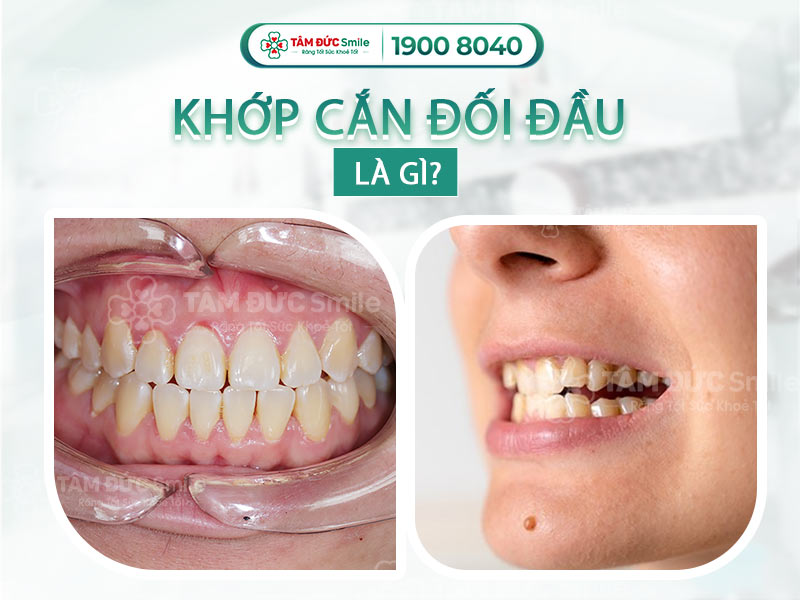 KHỚP CẮN ĐỐI ĐẦU: NGUYÊN NHÂN, ẢNH HƯỞNG VÀ CÁCH CHỮA TRỊ