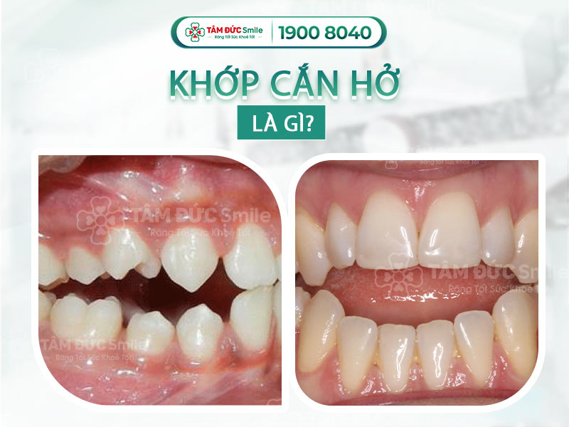 KHỚP CẮN HỞ LÀ GÌ? NIỀNG RĂNG KHỚP CẮN HỞ MẤT BAO LÂU