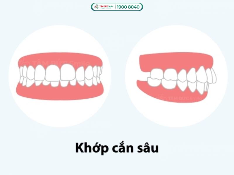 Khớp cắn sâu là gì