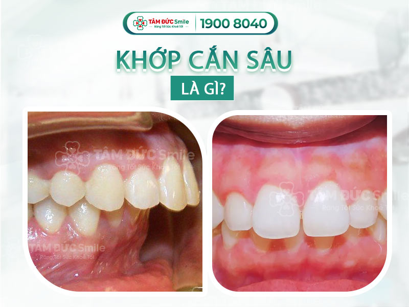 KHỚP CẮN SÂU LÀ GÌ? ẢNH HƯỞNG VÀ CÁCH CHỮA TRỊ KHỚP CẮN SÂU