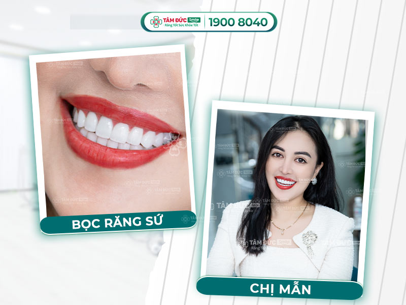 LÀM 4 RĂNG CỬA BỌC SỨ CÓ ĐƯỢC KHÔNG? GIÁ BAO NHIÊU TIỀN?