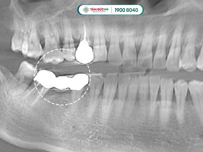 Làm cầu răng sứ có tốt không?