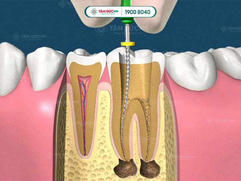 lấy tuỷ răng có đau không