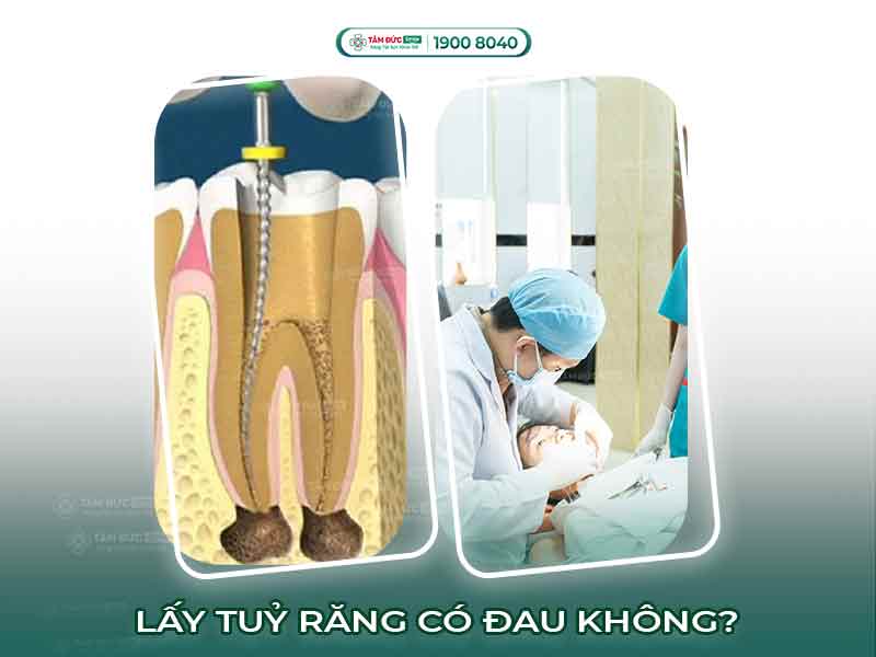 LẤY TỦY RĂNG CÓ ĐAU KHÔNG? VÌ SAO QUÝ KHÁCH NÊN LẤY TỦY RĂNG?