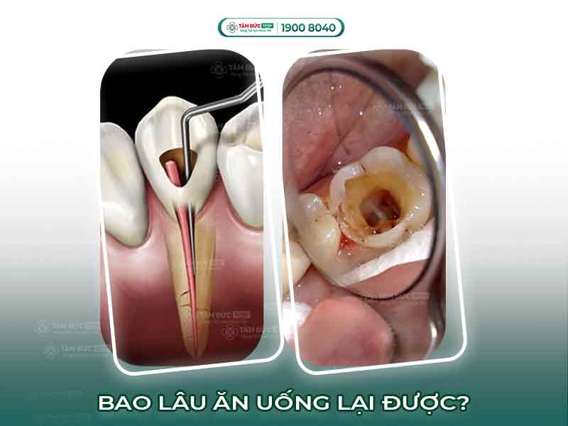 LẤY TỦY RĂNG XONG BAO LÂU MỚI ĂN UỐNG BÌNH THƯỜNG TRỞ LẠI?