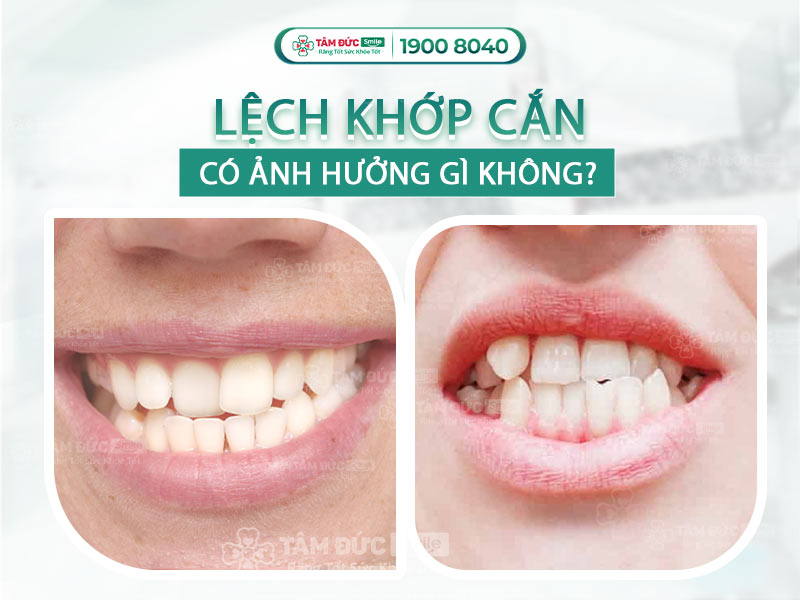 LỆCH KHỚP CẮN LÀ GÌ? NHỮNG PHƯƠNG PHÁP KHẮC PHỤC LỆCH KHỚP CẮN AN TOÀN