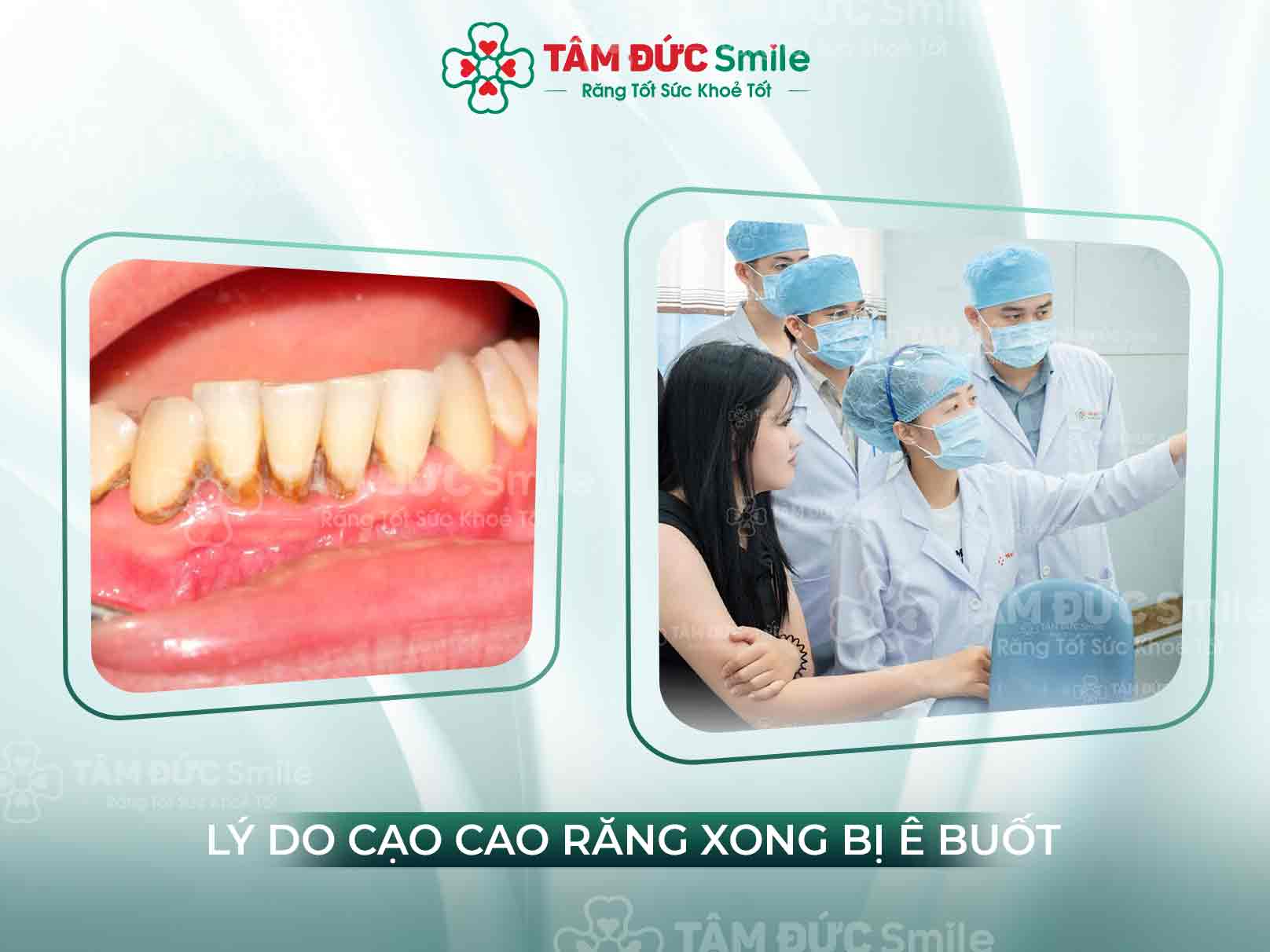 5+ LÝ DO LẤY CAO RĂNG XONG BỊ Ê BUỐT