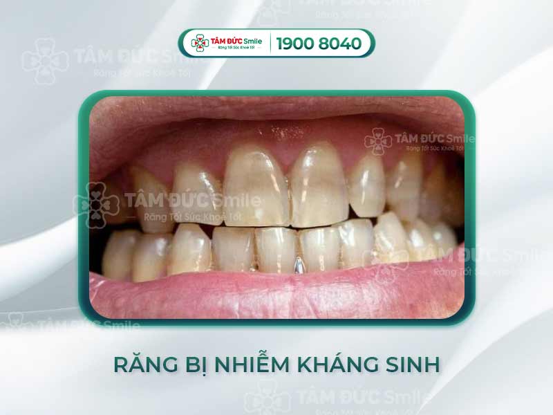 LÝ DO RĂNG BỊ NHIỄM KHÁNG SINH TETRACYCLINE VÀ CÁCH KHẮC PHỤC