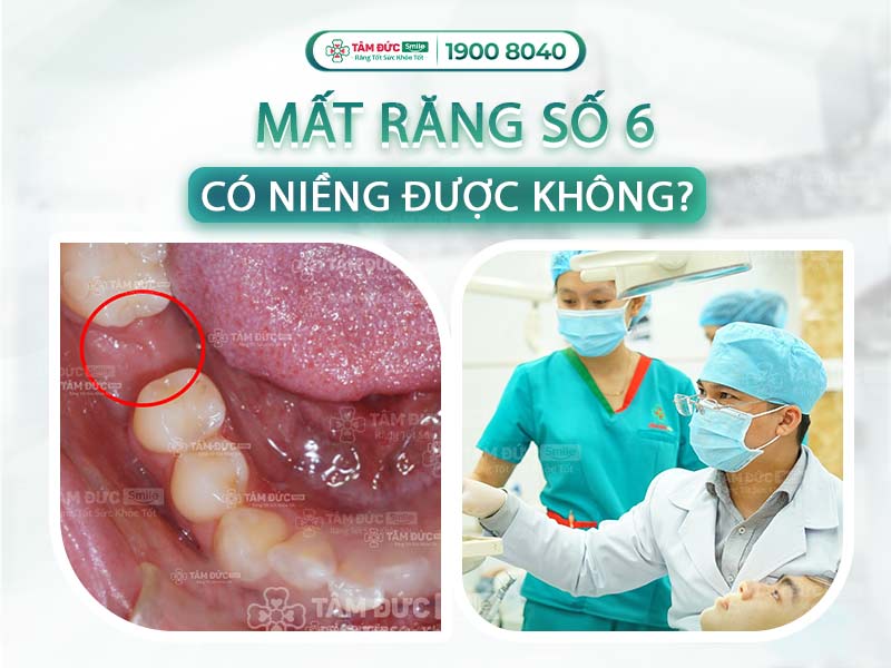 MẤT RĂNG SỐ 6 CÓ NIỀNG ĐƯỢC KHÔNG? PHƯƠNG PHÁP NIỀNG RĂNG PHÙ HỢP CHO QUÝ KHÁCH