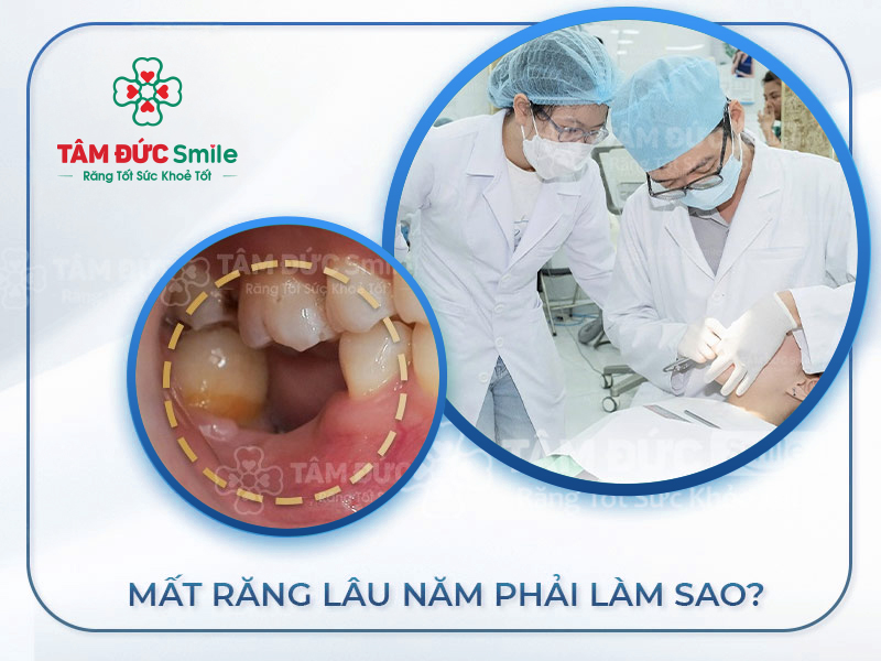 MẤT RĂNG LÂU NĂM CÓ TRỒNG RĂNG IMPLANT ĐƯỢC KHÔNG?