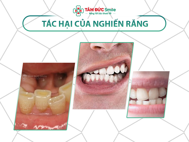 NGHIẾN RĂNG CÓ ẢNH HƯỞNG GÌ KHÔNG? GIẢI PHÁP KHẮC PHỤC