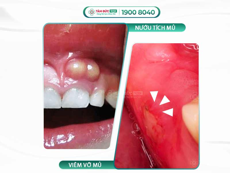 NGUYÊN NHÂN BỊ VIÊM NƯỚU RĂNG CÓ MỦ? CÁCH ĐIỀU TRỊ HIỆU QUẢ