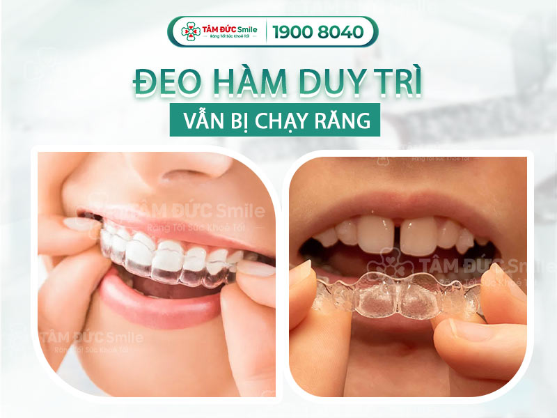 TOP 3+ NGUYÊN NHÂN ĐEO HÀM DUY TRÌ VẪN BỊ CHẠY RĂNG VÀ CÁCH KHẮC PHỤC