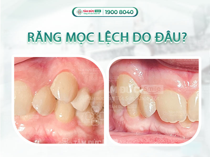 NGUYÊN NHÂN RĂNG MỌC LỆCH Ở TRẺ VÀ CÁCH KHẮC PHỤC