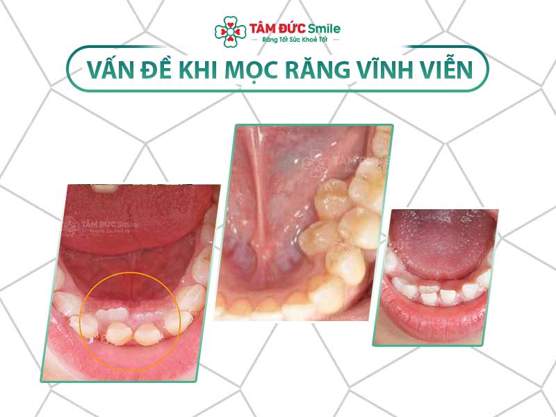 NGUYÊN NHÂN RĂNG SỮA CHƯA RỤNG RĂNG VĨNH VIỄN ĐÃ MỌC VÀ CÁCH KHẮC PHỤC