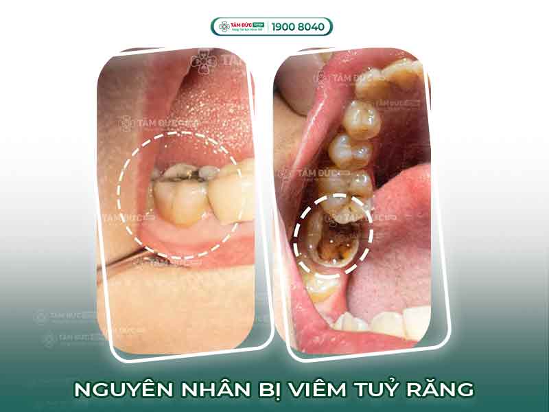 NGUYÊN NHÂN VÀ CÁCH ĐIỀU TRỊ VIÊM TỦY RĂNG CẤP